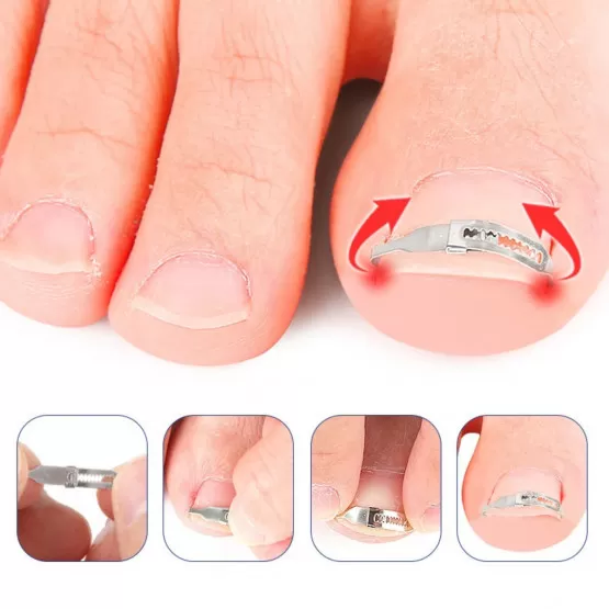 INF Verstellbare Korrekturklammer für eingewachsene Zehennägel - 2 Stk. Edelstahl Nagelglätter