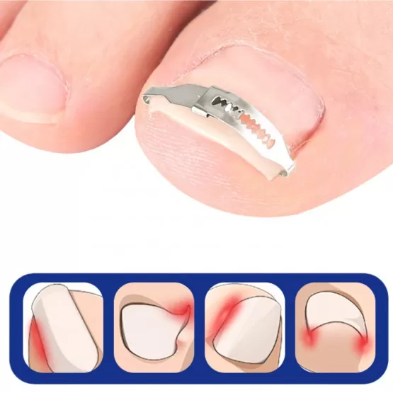 INF Verstellbare Korrekturklammer für eingewachsene Zehennägel - 2 Stk. Edelstahl Nagelglätter